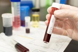 توضیحات لازم درباره افشای اطلاعات محرمانه بیماران HIV در آزمایشگاه‌ها